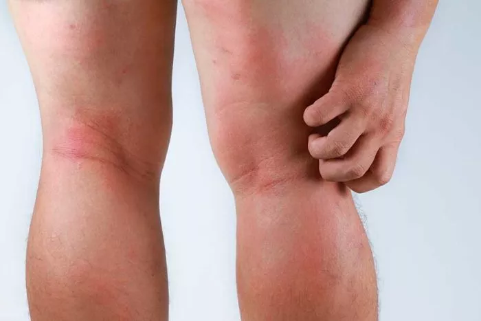 Eczema-on-Legs