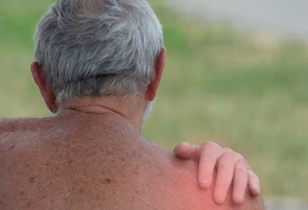 Eczema-on-Shoulders-Back