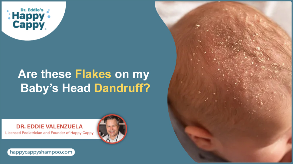 Are these Flakes on my Baby’s Head Dandruff?