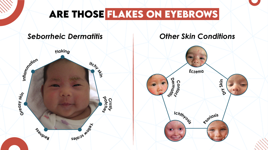 Are Those Flakes on Eyebrows Seborrheic Dermatitis? 