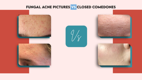 Fungal Acne Vs Closed Comedones Whats The Difference Happy Cappy