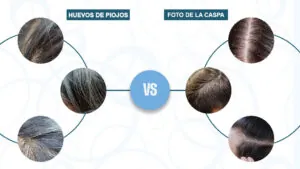 Imágenes de huevos de piojos vs caspa