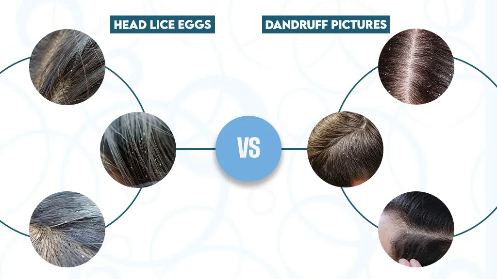 Head Lice Eggs Vs Dandruff Pictures 