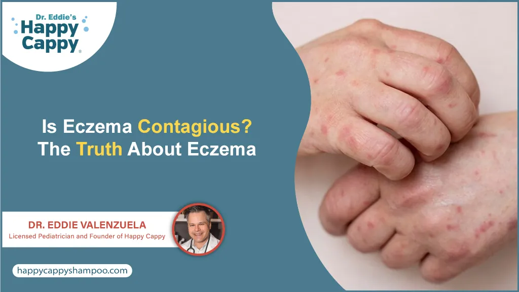 Is Eczema Contagious?