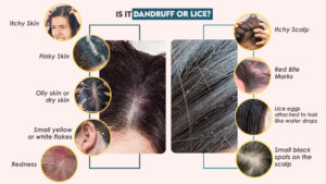 Is It Dandruff or Lice?