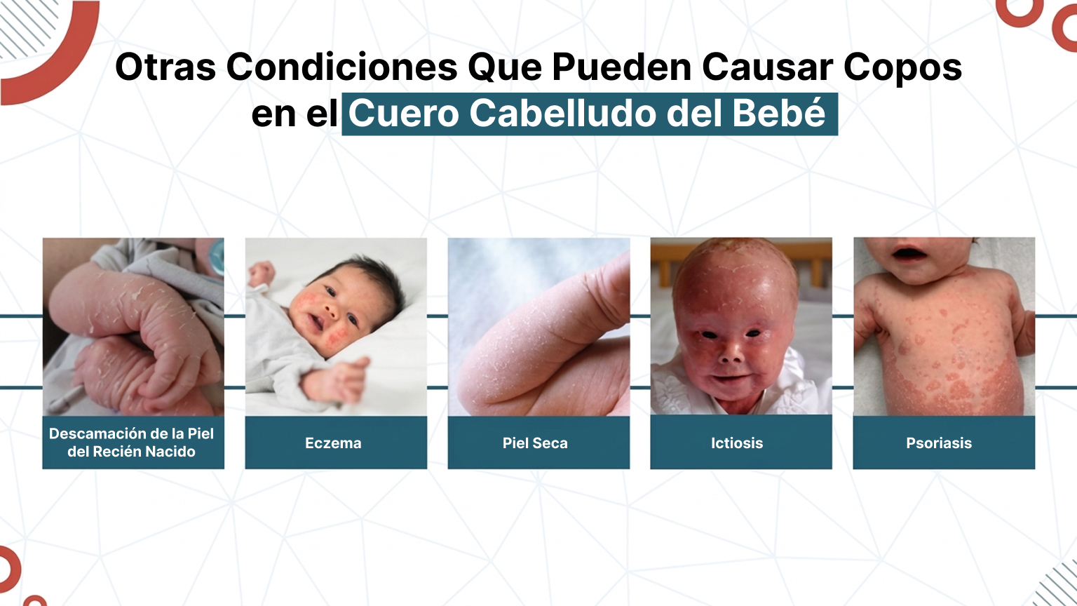 Otras Condiciones Que Pueden Causar Copos en el Cuero Cabelludo del Bebé