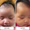 cradle cap before and after