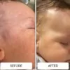 cradle cap before and after