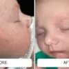 cradle cap before and after