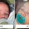 Neonatal-acne-before-and-after