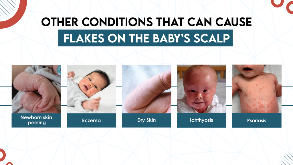 Other Conditions That Can Cause Flakes on the Baby’s Scalp 