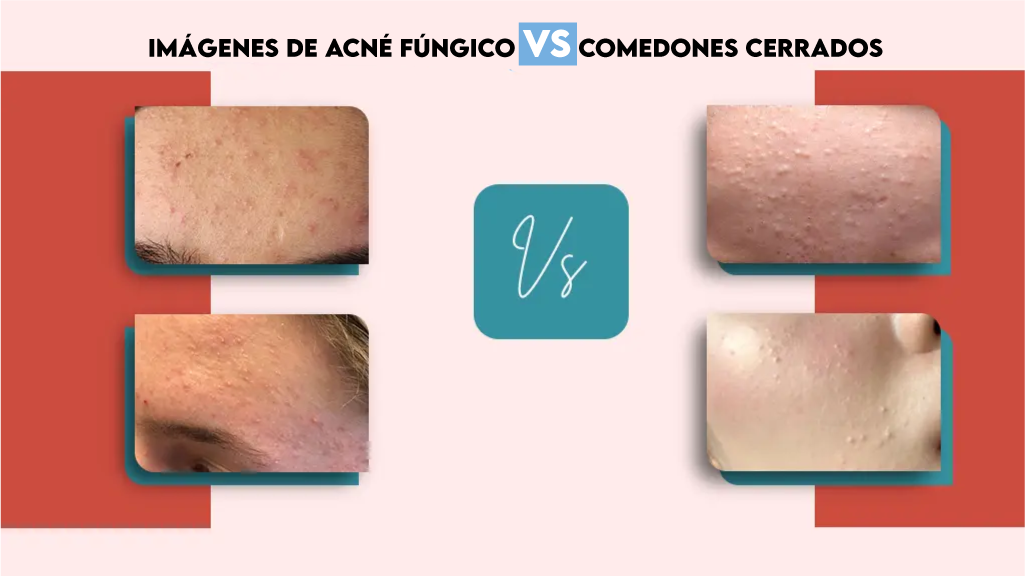 Imágenes de Acné Fúngico Vs Comedones Cerrados