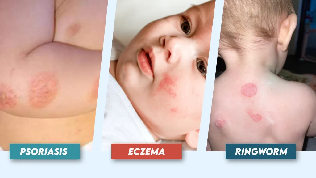 Psoriasis Vs Eczema Vs Ringworm