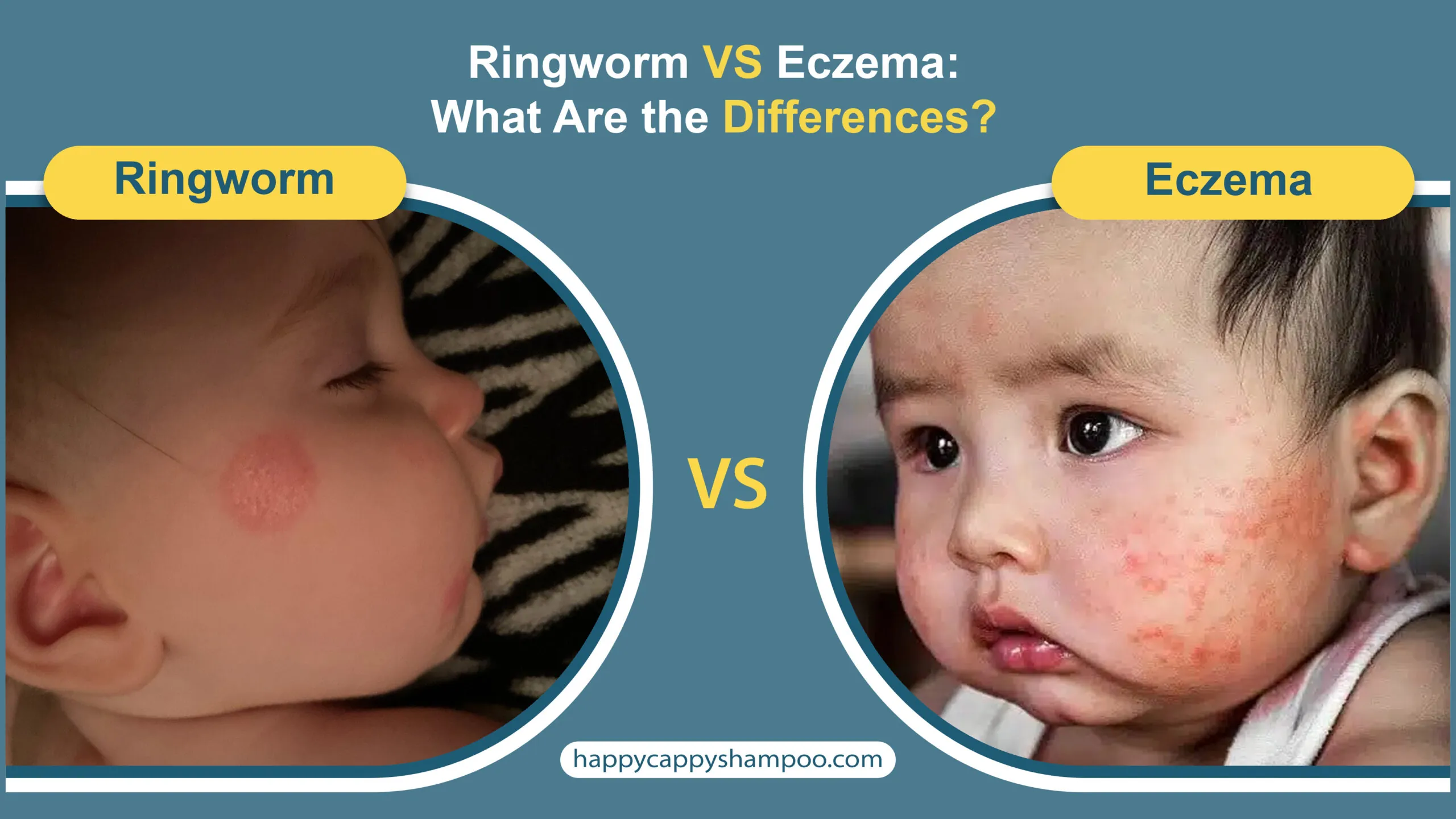 Ringworm VS Eczema: What Are the Differences?