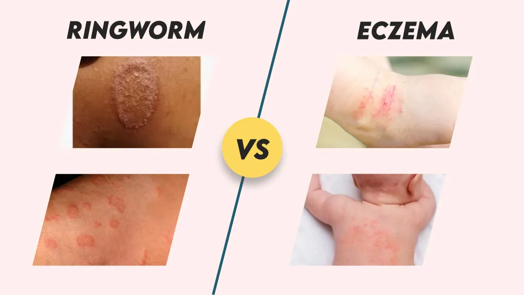 Ringworm Vs Eczema Pictures