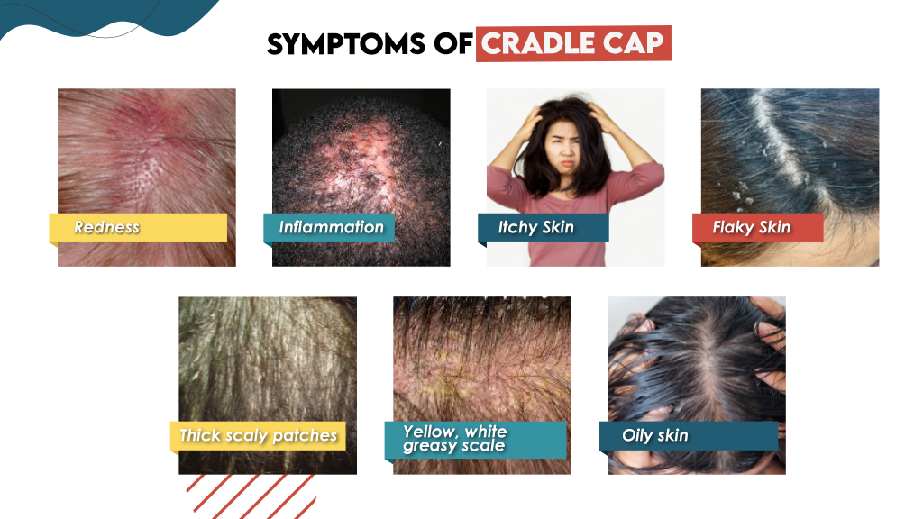 Symptoms of Cradle cap