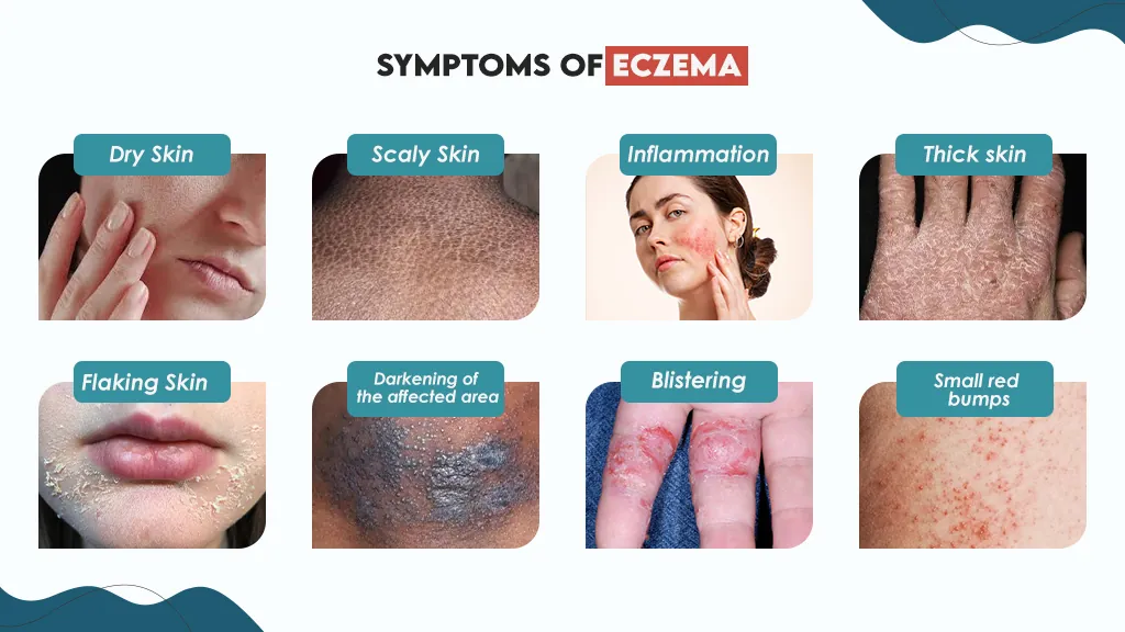 Symptoms of Eczema