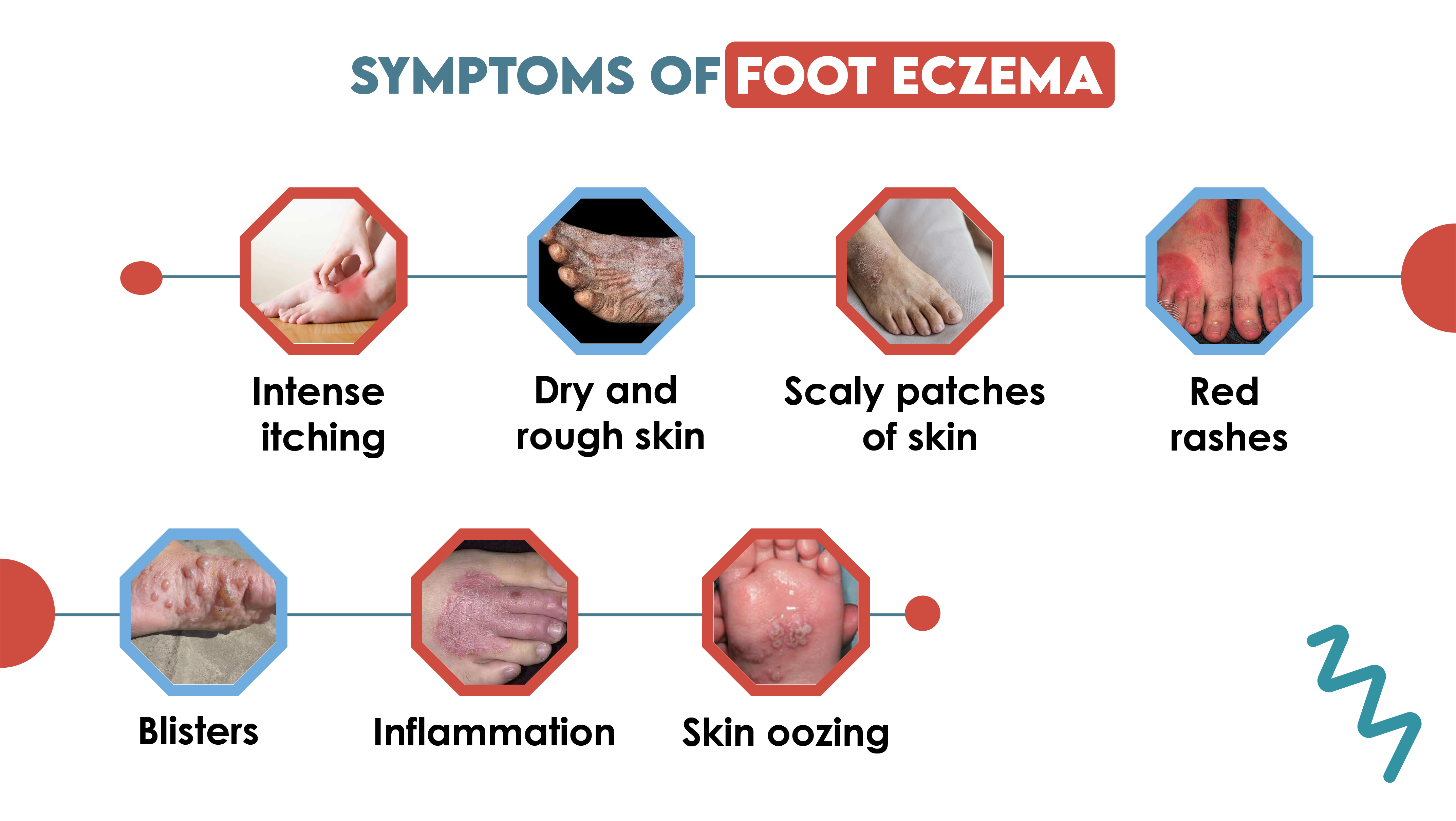 Symptoms of Foot Eczema