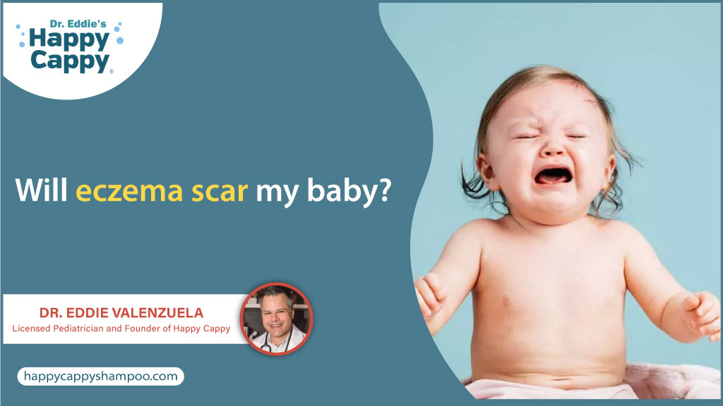 Will eczema scar my baby?