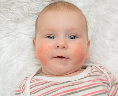 ECZEMA ON BABY FACE