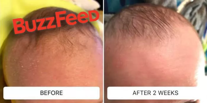 Most Buzzed About Solution For Kid’s Cradle Cap!