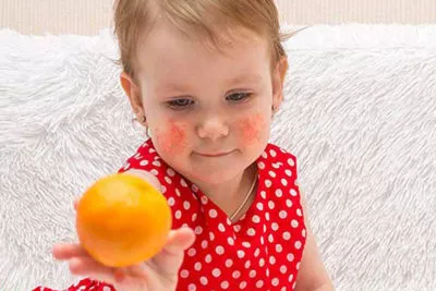 What Is Atopic Dermatitis?
