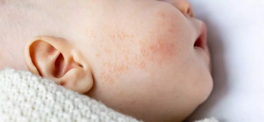 A baby’s cheek shows signs of neonatal acne.
