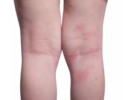 Eczema on legs