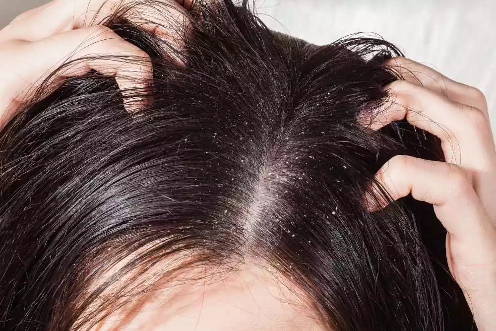Lice Eggs vs. Dandruff: What’s the Difference?