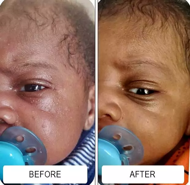 cradle cap before and after