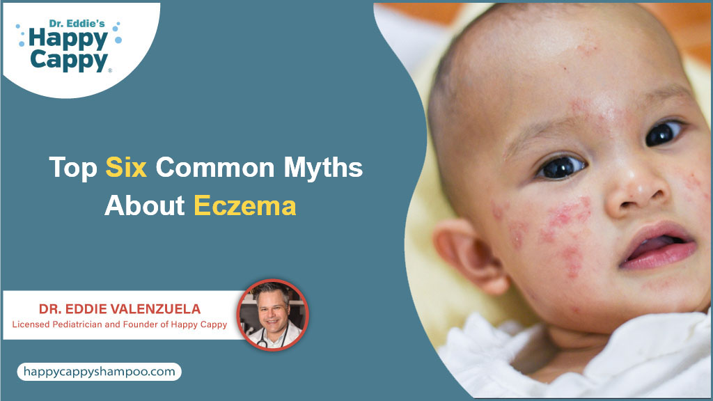 top six common myths about eczema