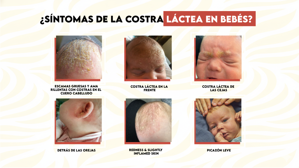 Síntomas de la Costra Láctea en Bebés