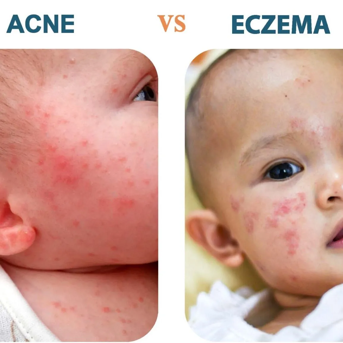 Newborn baby acne discount