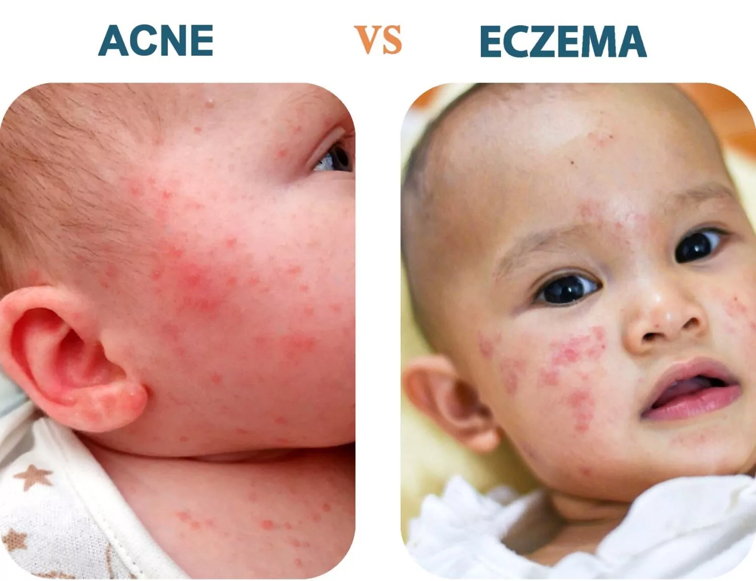 Acné Neonatal vs Eczema: Entender La Diferencia