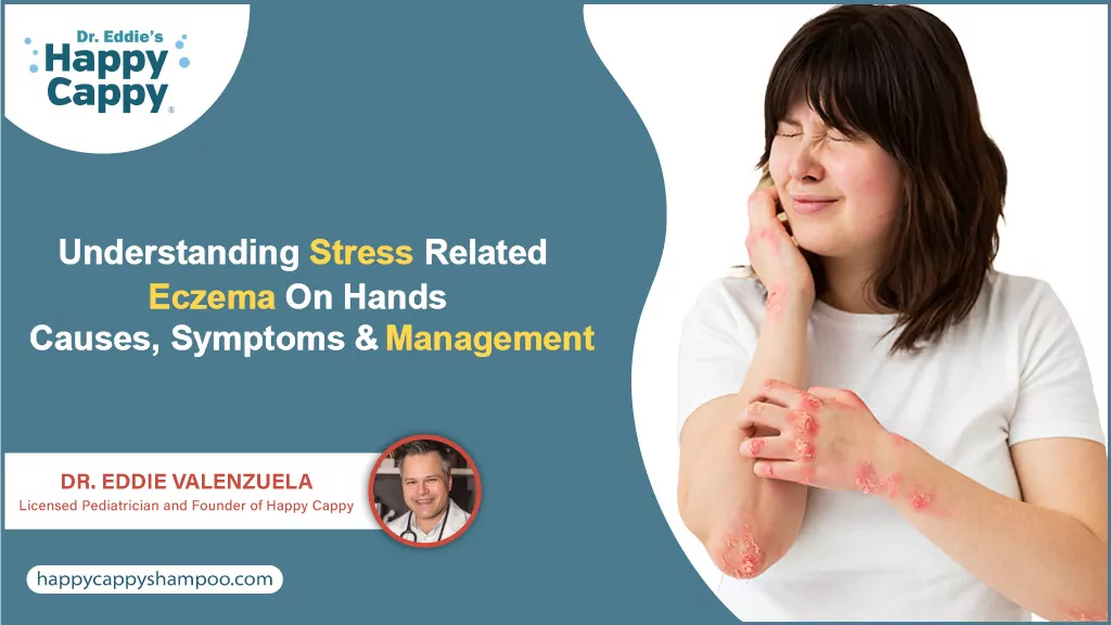 Stress Related Eczema On Hands