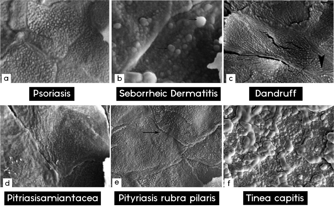 Six scanning electron microscopy panels comparing surface scales from psoriasis, seborrheic dermatitis, dandruff, pityriasis amiantacea, pityriasis rubra pilaris, and tinea capitis.
