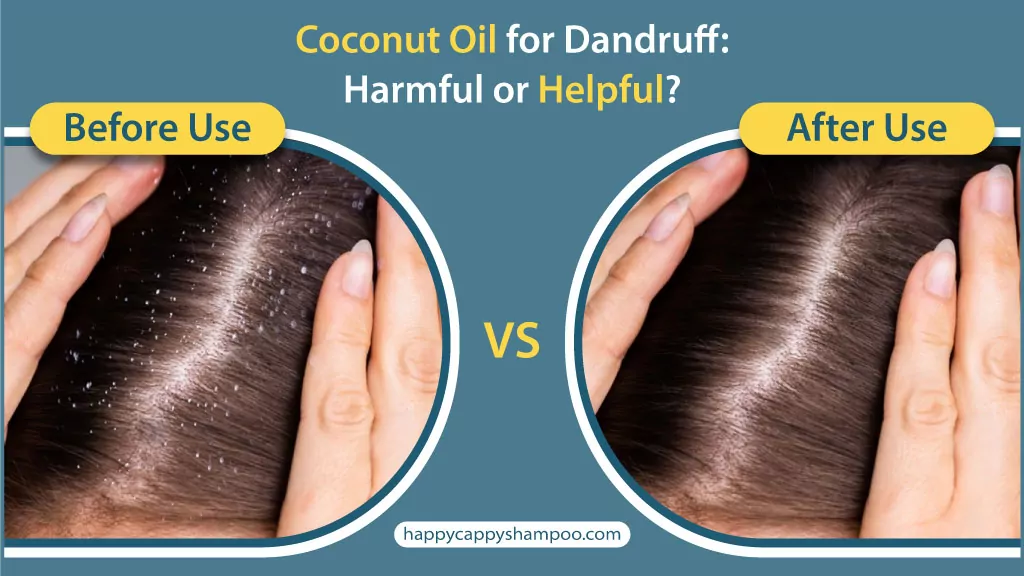 Coconut Oil for Dandruff: Harmful or Helpful?