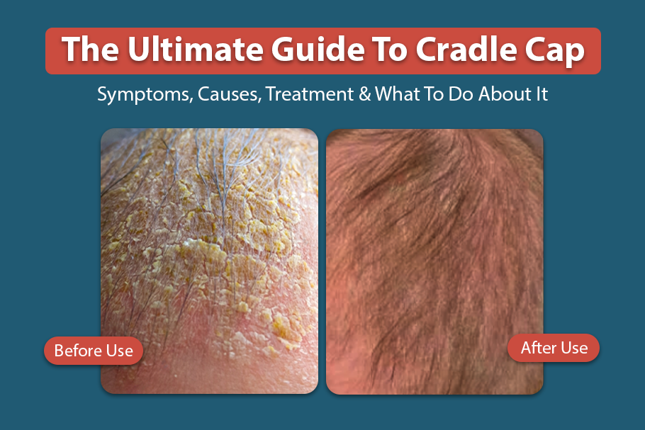Cradle Cap Symptoms, Causes, treatment
