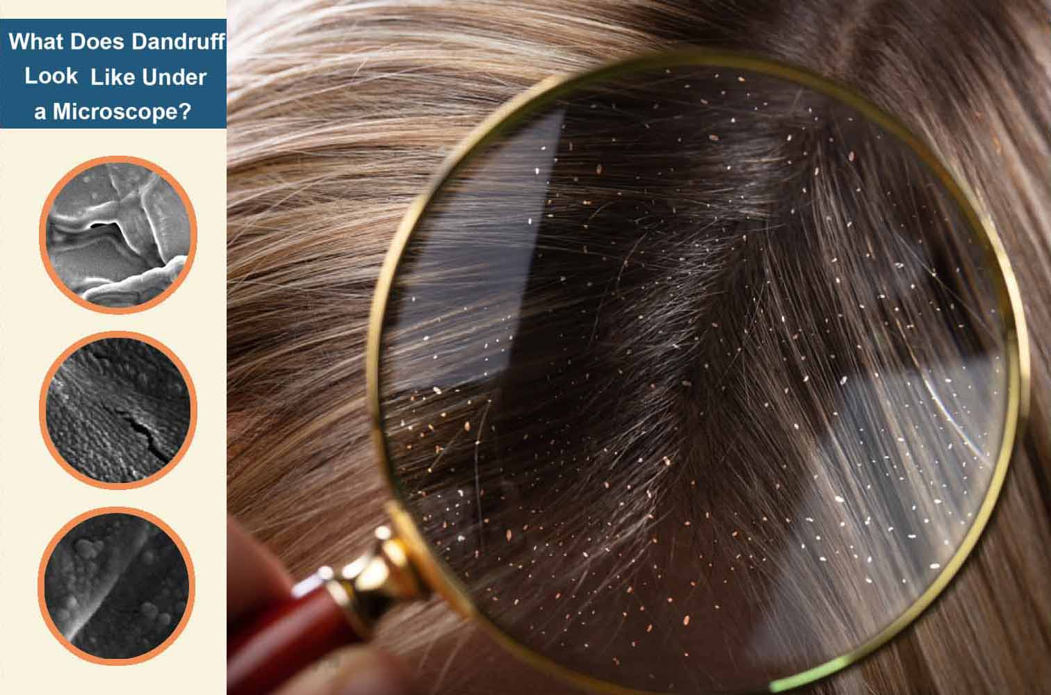 How Does Dandruff Look Under a Microscope?