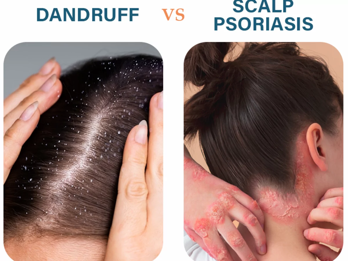 Psoriasis del cuero cabelludo VS Caspa: Diferencias - Dr. Eddie's Happy  Cappy