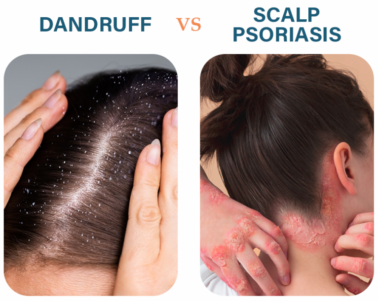 Scalp Psoriasis Vs. Dandruff: The Epic Clash You Didn't See Coming