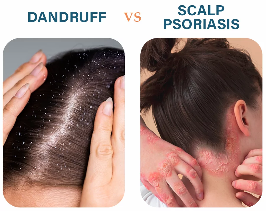 Psoriasis del cuero cabelludo VS Caspa: Diferencias