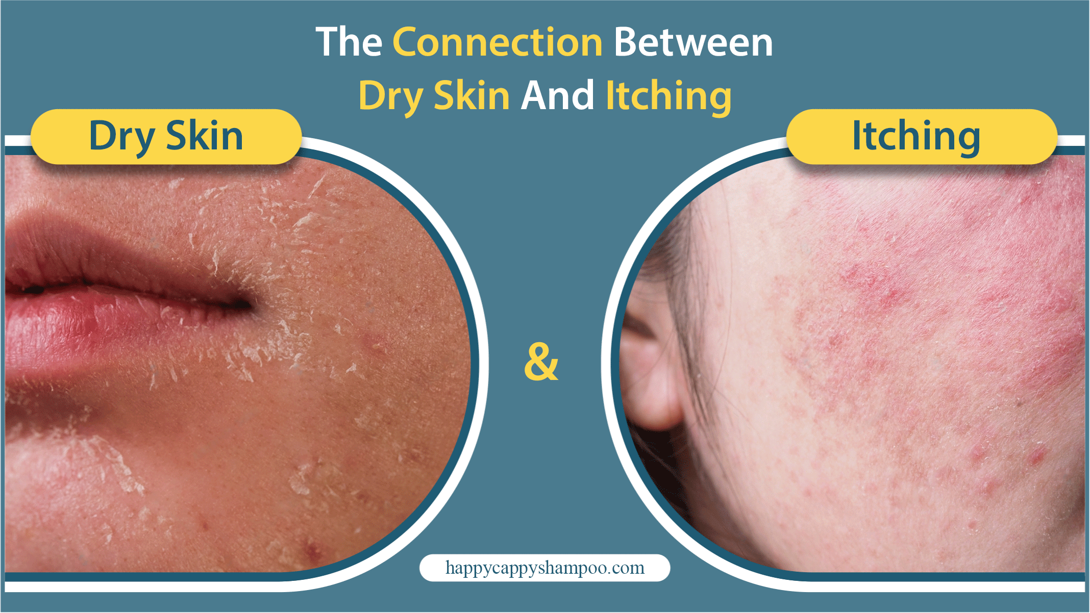 Dry Skin and Itching