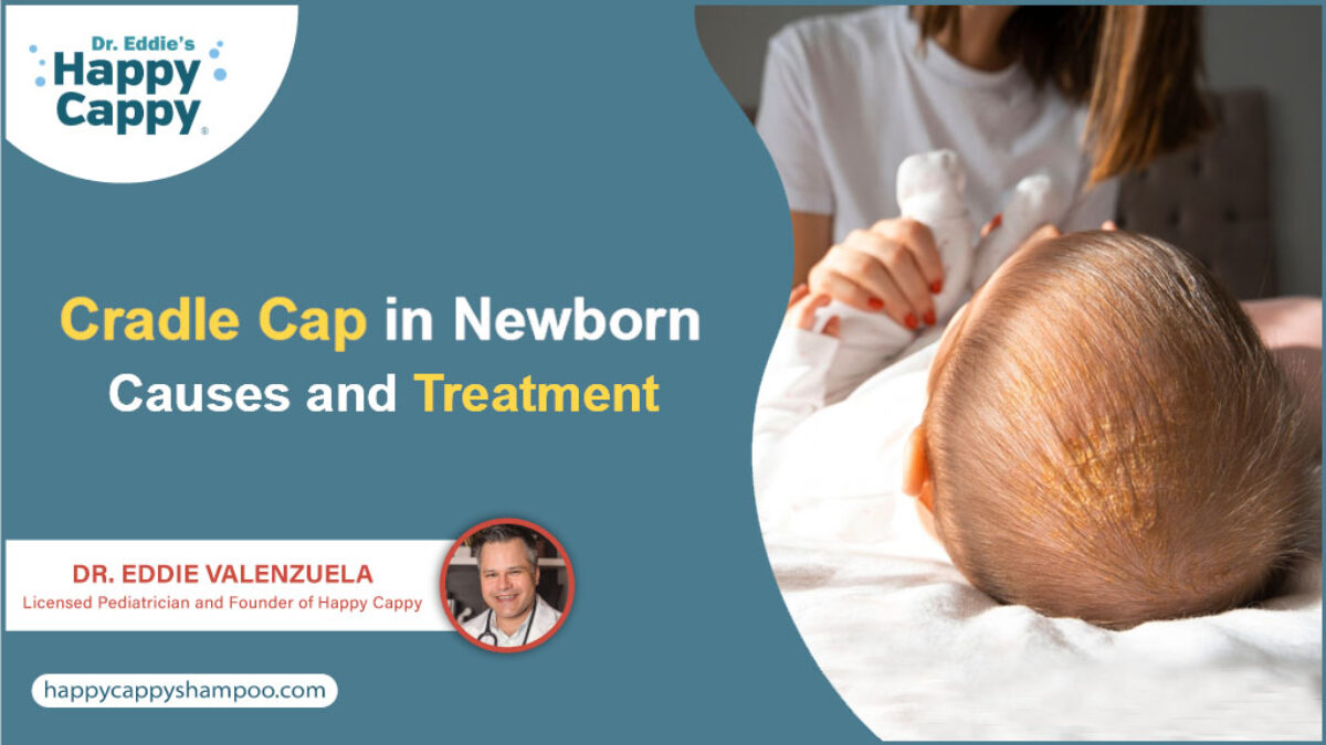 Cradle Cap: Causes and Treatment