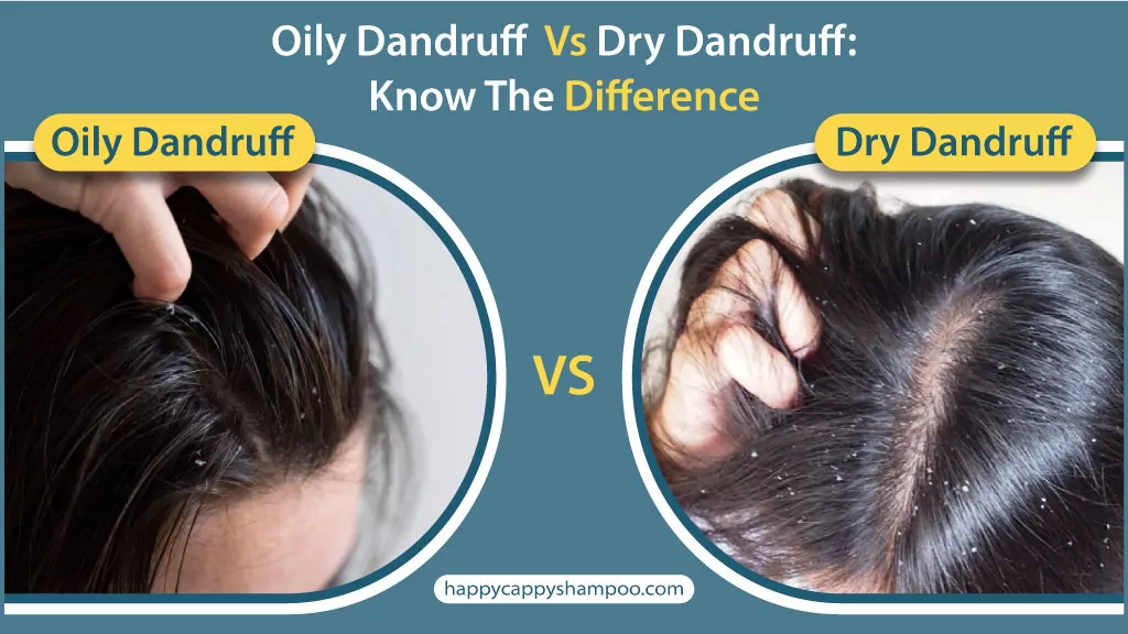 Oily Dandruff VS Dry Dandruff