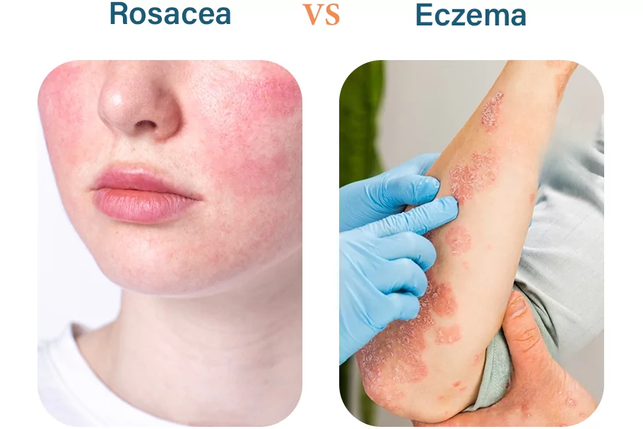 Rosácea vs. eczema: Explicación de las afecciones cutáneas más comunes