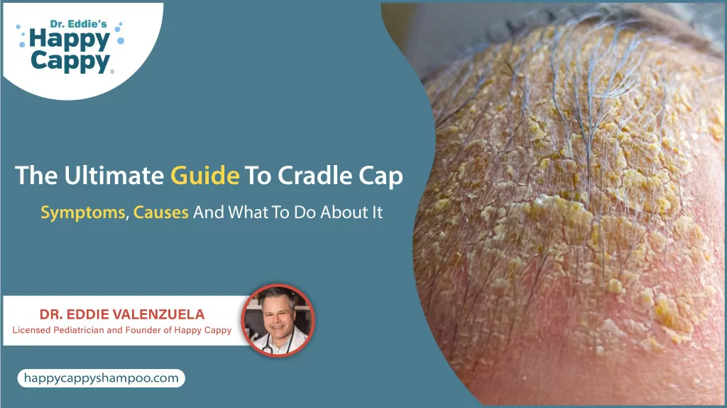 The Ultimate Guide To Cradle Cap: Symptoms, Causes And What To Do About It 