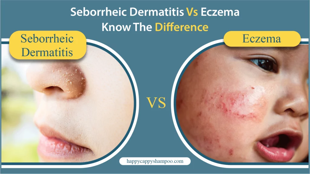 Seborrheic Dermatitis Vs Eczema Know The Difference