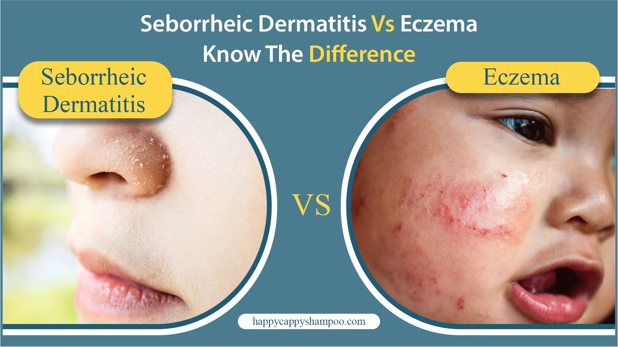 Seborrheic Dermatitis vs Eczema: Know The Difference
