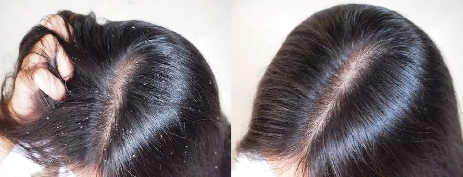 Before And After Dandruff Treatment